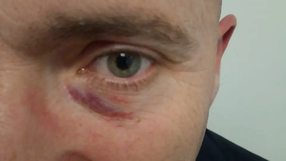 Agresión al coordinador local de Vox en Pontevedra. DP