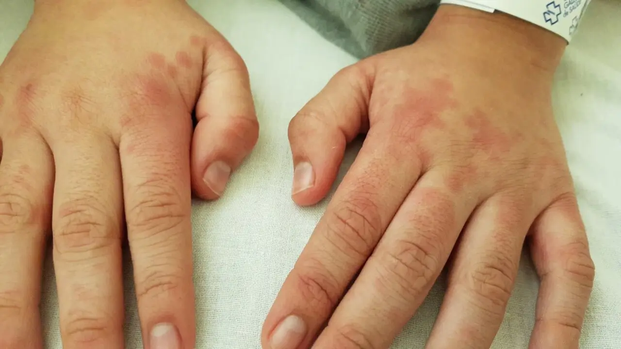 A Aaron le salen exantemas por todo el cuerpo cuando sufre brotes de AIJ. CEDIDA