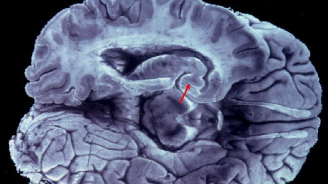 Imagen de un cerebro que muestra lesiones características de la enfermedad de Alzheimer. ARCHIVO