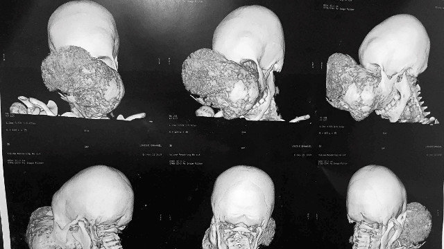 Un TAC con diferentes imaxes do tumor de Emmanuelle antes da intervención. TAC