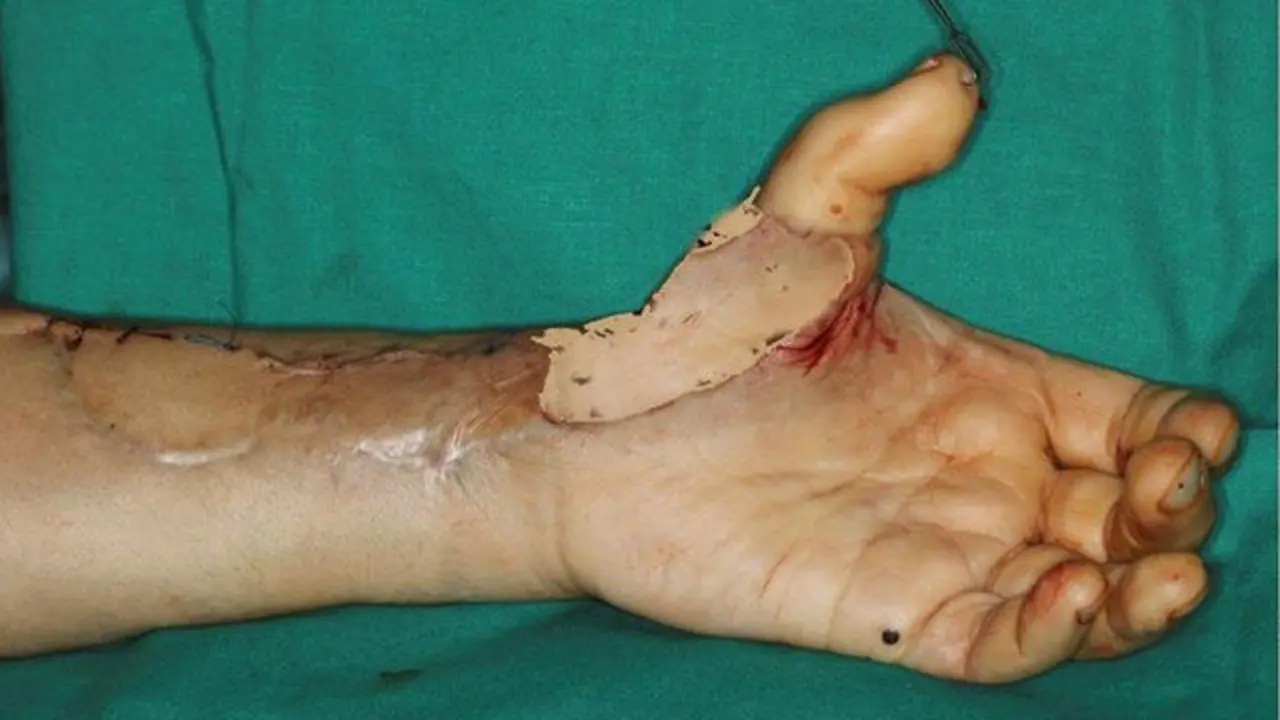 Mano con el dedo trasplantado. FRANCISCO DEL PIÑAL