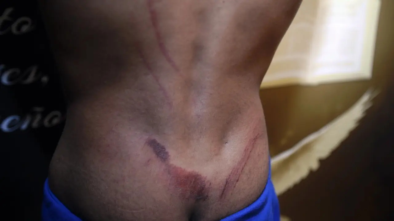 Heridas sufridas por uno de los agentes en el altercado. AEP