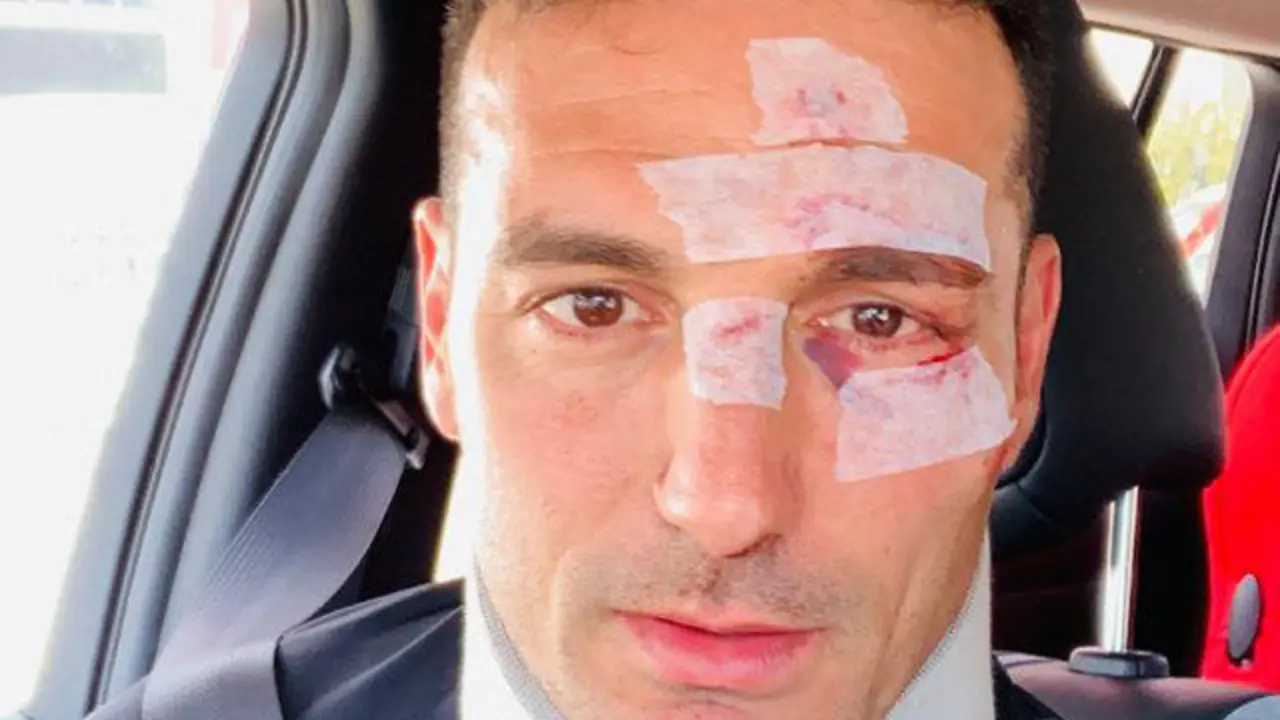 Lionel Scaloni, tras recibir el alta. TWITTER