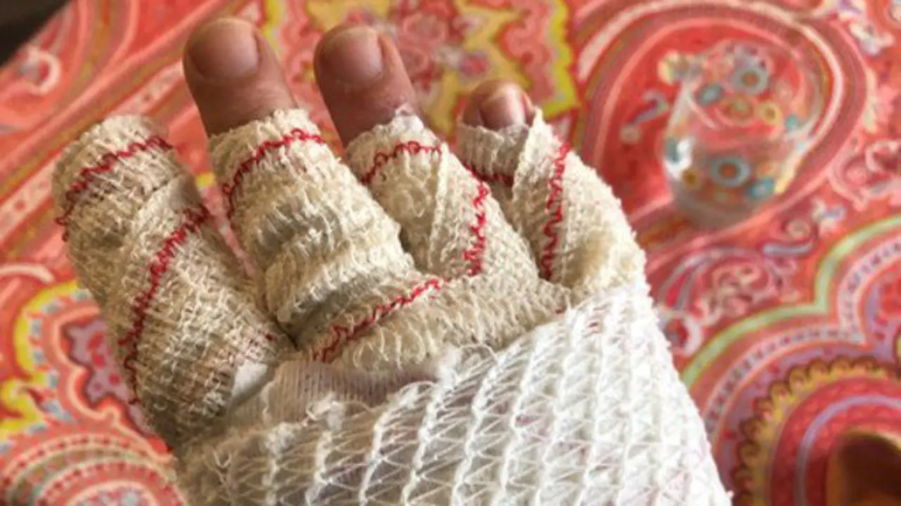 La mano quemada de Xulio Ferreiro. TWITTER