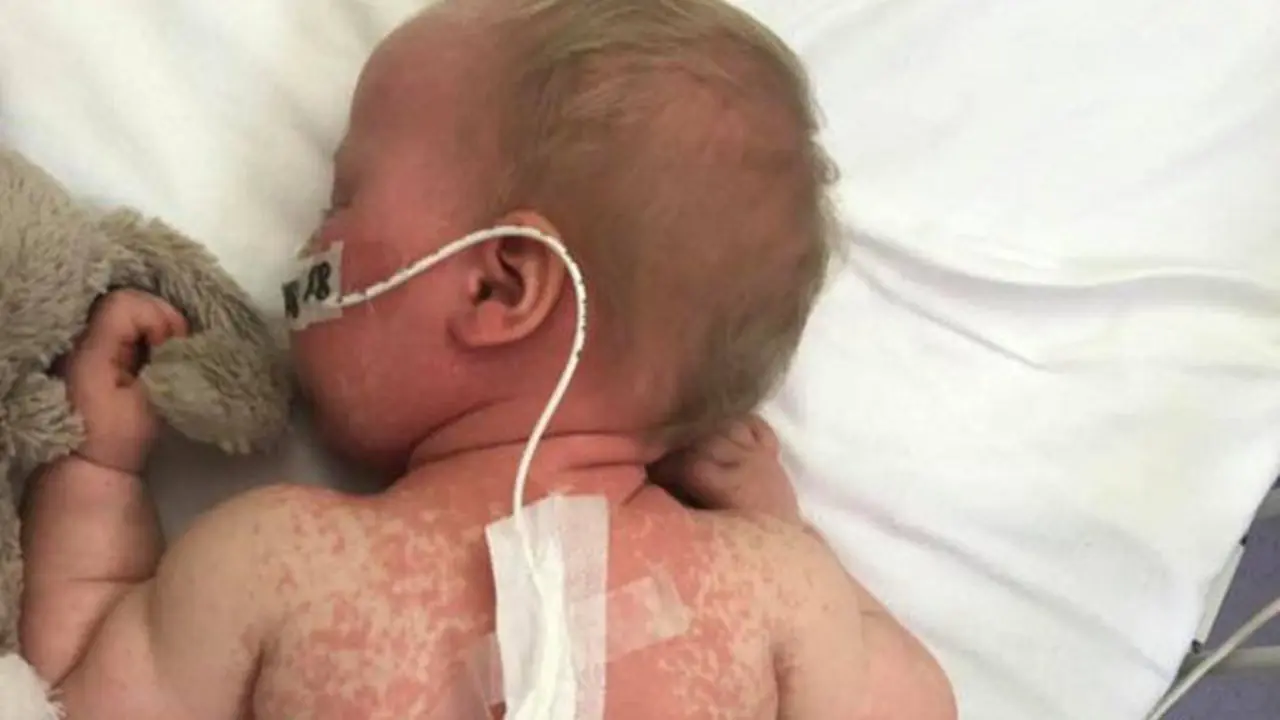 Niña contagiada de sarampión. FACEBOOK (Jilly Moss)