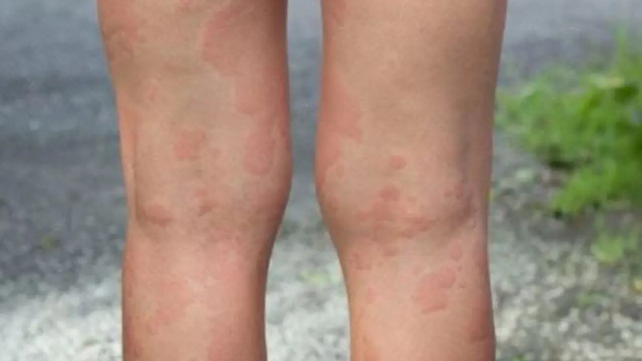 Manchas rojas en la piel. EP