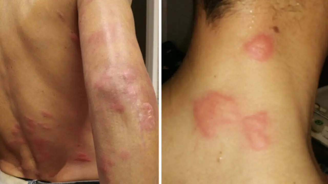 El lucense sufrió numerosas picaduras en el tren. EP