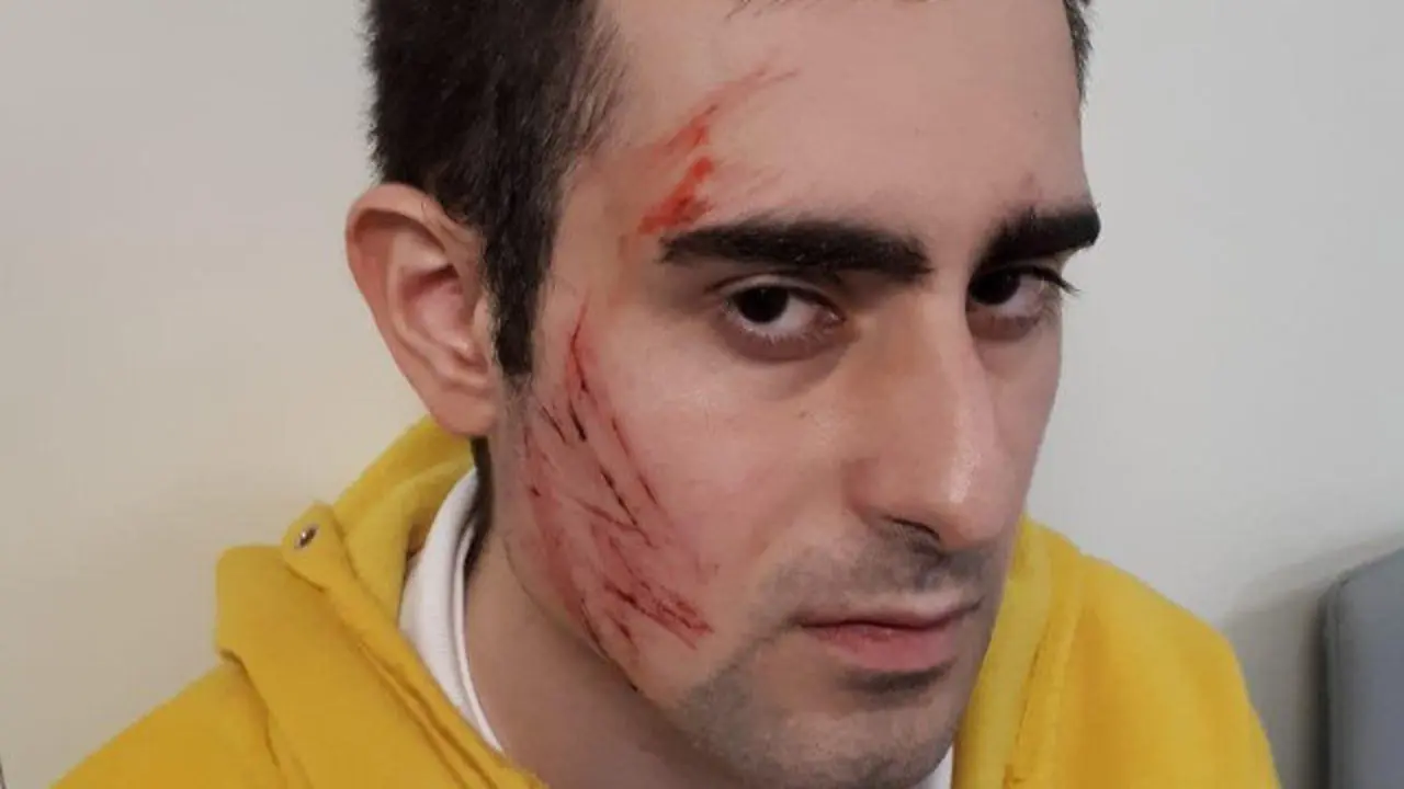 El doberman le causó heridas en la cara. DP