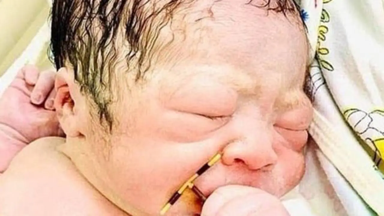 El bebé agarrado al DIU. HAI PHONG INTERNATIONAL HOSPITAL