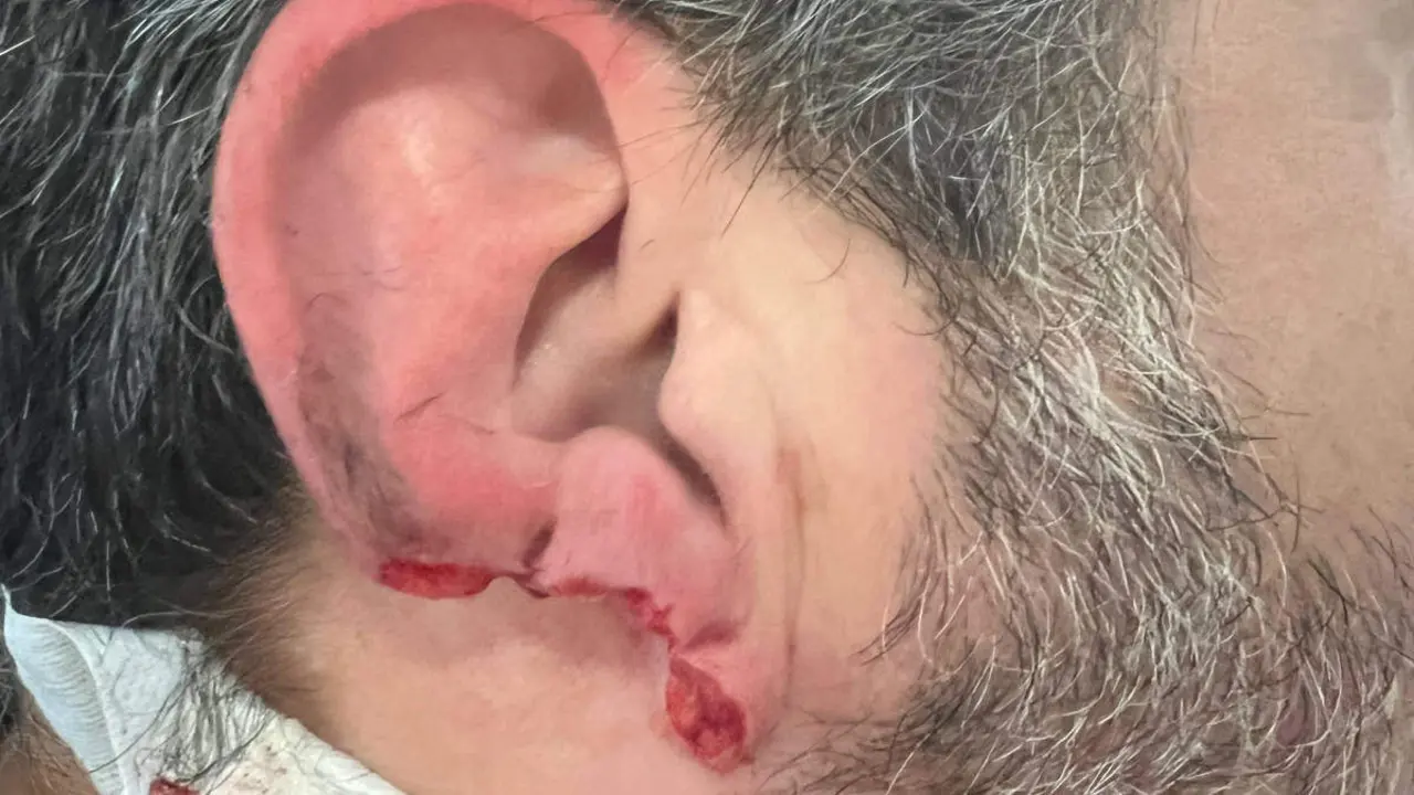 El vigilante agredido en el Hospital de Oza perdió parte del lóbulo y del cartílago de la oreja derecha. EP