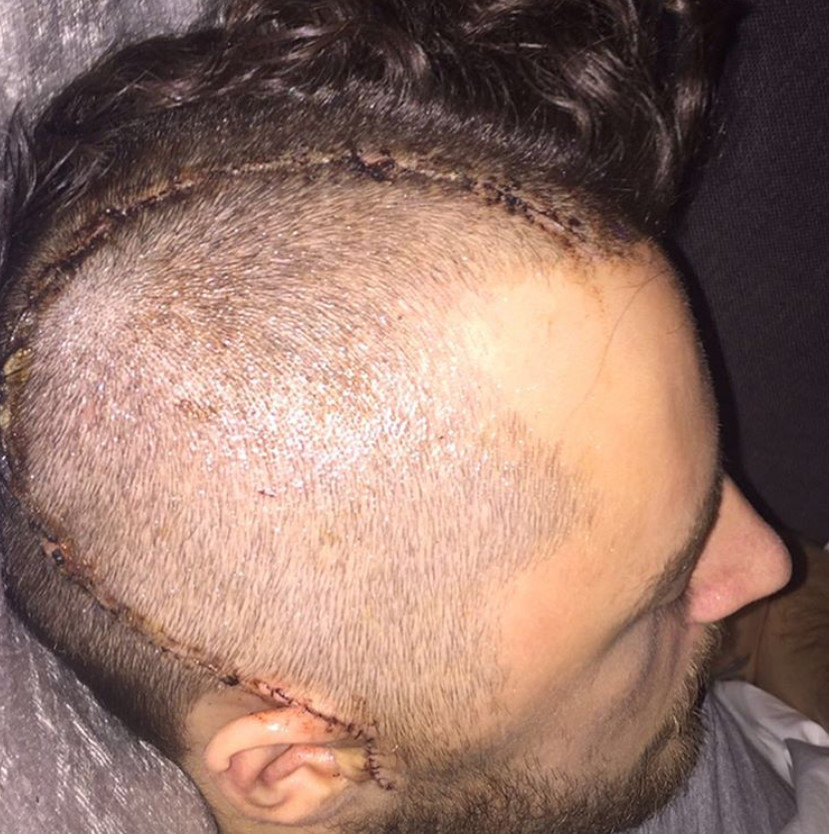 Cicatriz en la cabeza de Ryan Mason