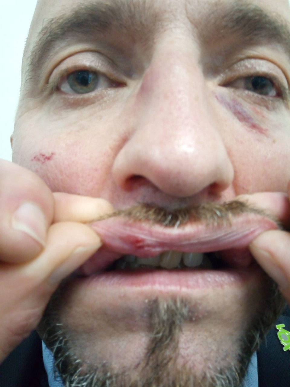 Imagen del coordinador de Vox en Pontevedra tras sufrir una agresión. DP