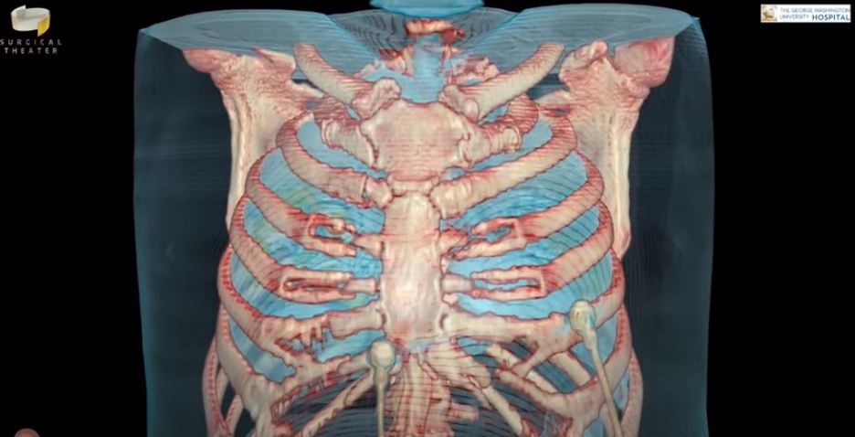 Recreación de los daños del coronavirus en los pulmones. GEORGE WASHINGTON HOSPITAL