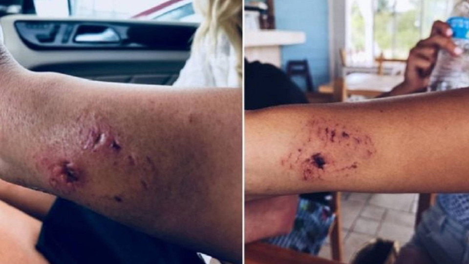 El brazo de la modelo tras la mordedura. KATARINA ZARUTSKIE