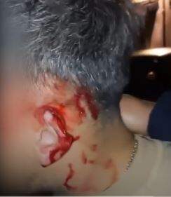 La oreja ensangrentada después del mordisco. EP.