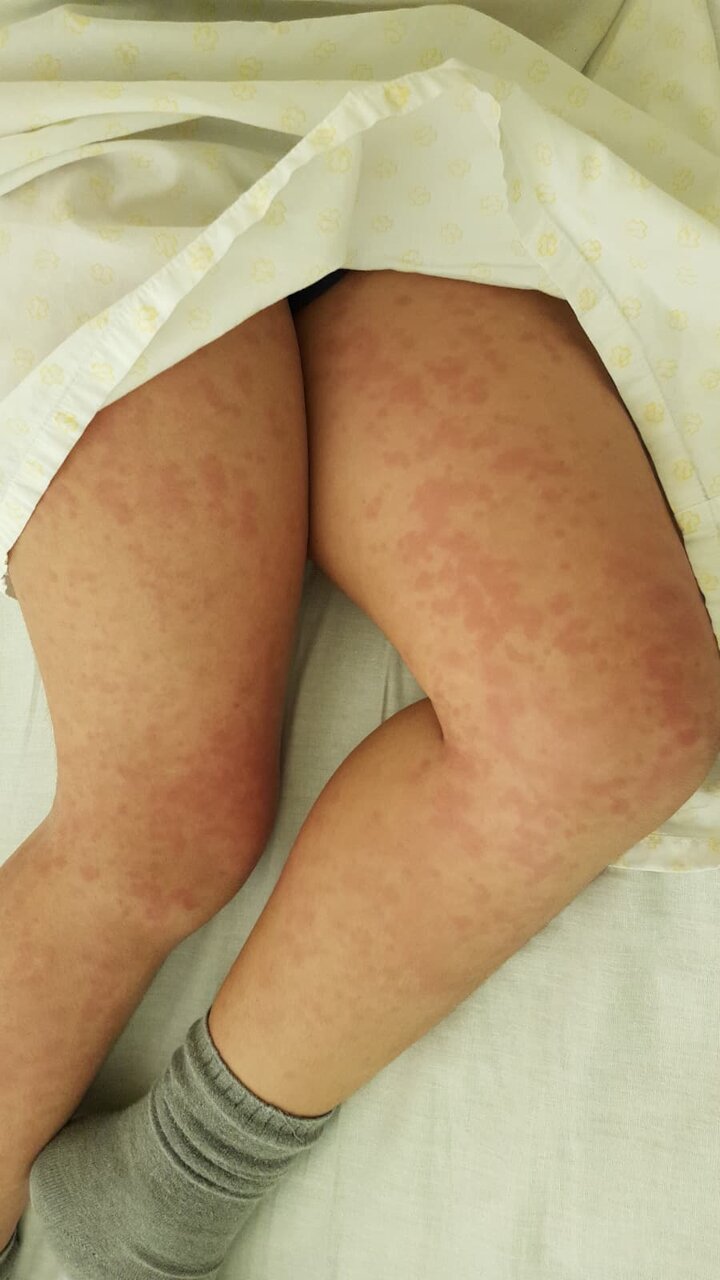 Las piernas de Aaron durante un brote de la enfermedad. CEDIDA